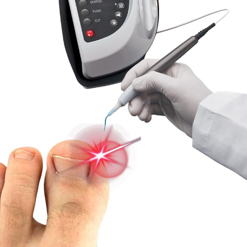 Laser Matricectomy