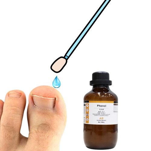 Phenol Matricectomy